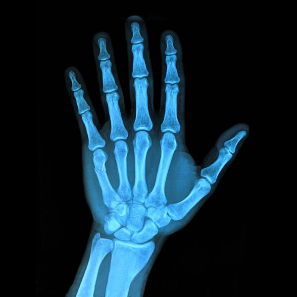 x-ray of a hand - deposit photos